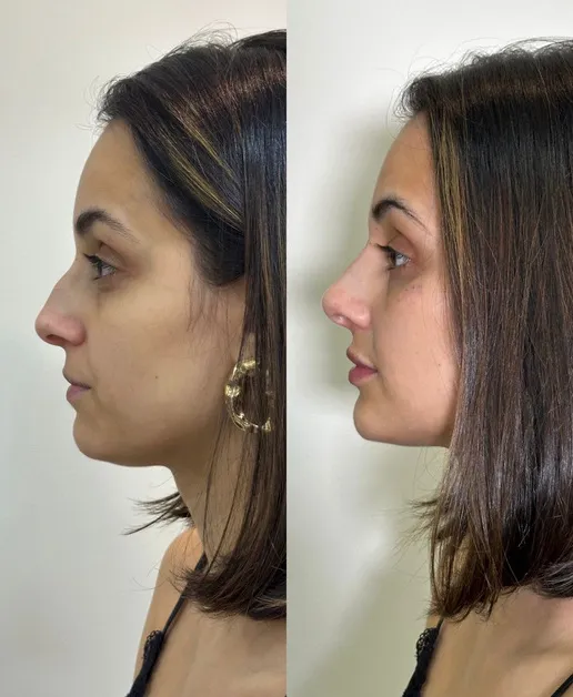 Perfiloplastia